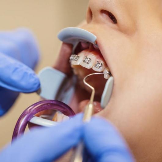  تقويم الفكين عند الأطفال : استثمار مبكر في ابتسامة صحية ومستقبل أفضل     