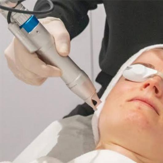   الجمال بلا ألم: جهاز “البيكو ليزر” يعيد تعريف علاج البشرة بنتائج مذهلة وفورية   